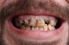 depositphotos_86924100-stock-photo-bad-teeth-smoker-sick.jpg